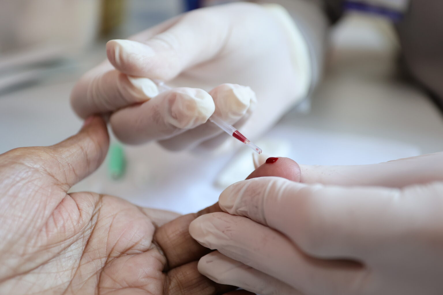 Prefeitura reforça ações de prevenção e diagnóstico das hepatites virais