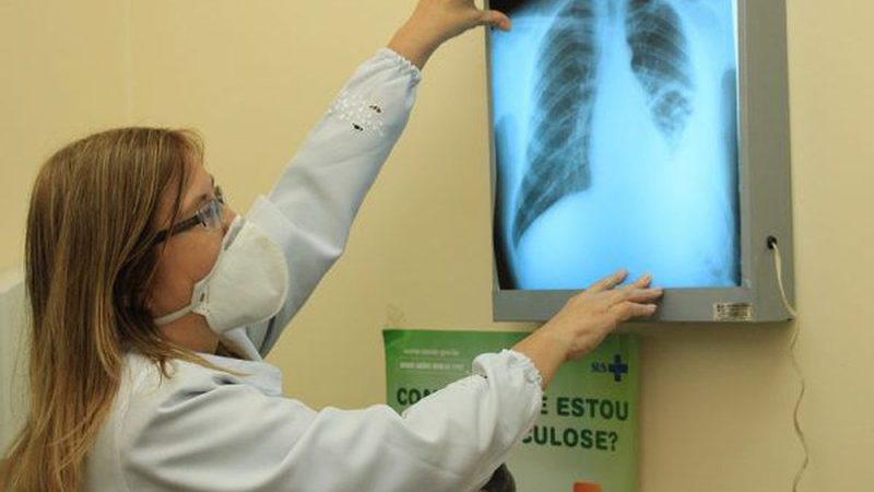 Prefeitura capacita equipes de saúde após aumento de casos de tuberculose em Dourados